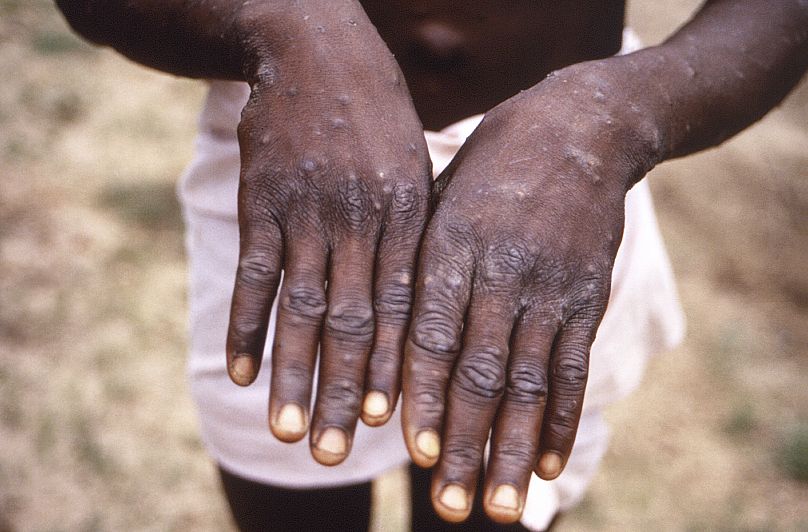 Cette image issue d'une enquête sur une épidémie de mpox, qui a eu lieu en République démocratique du Congo (RDC), montre les surfaces dorsales des mains d'un patient.
