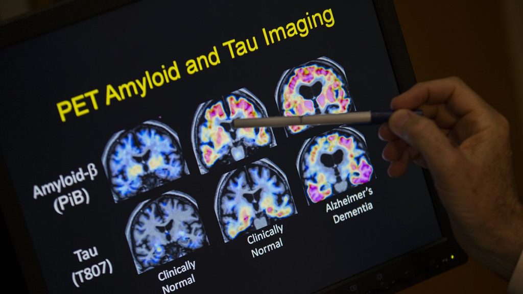 A doctor points to PET scan results that are part of a study on Alzheimer