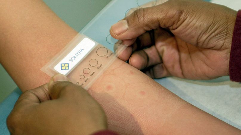 Un sujet participant à un essai clinique a fait mesurer les taches sur son bras pour déterminer l'absorption du vaccin contre la grippe administré à l'aide d'une nouvelle procédure testée.