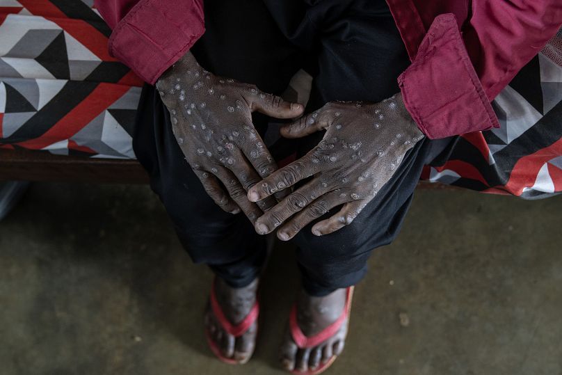 Un homme souffrant de MPOX attend d'être soigné à l'hôpital général de Kamituga au Sud-Kivu Congo, le 4 septembre 2024