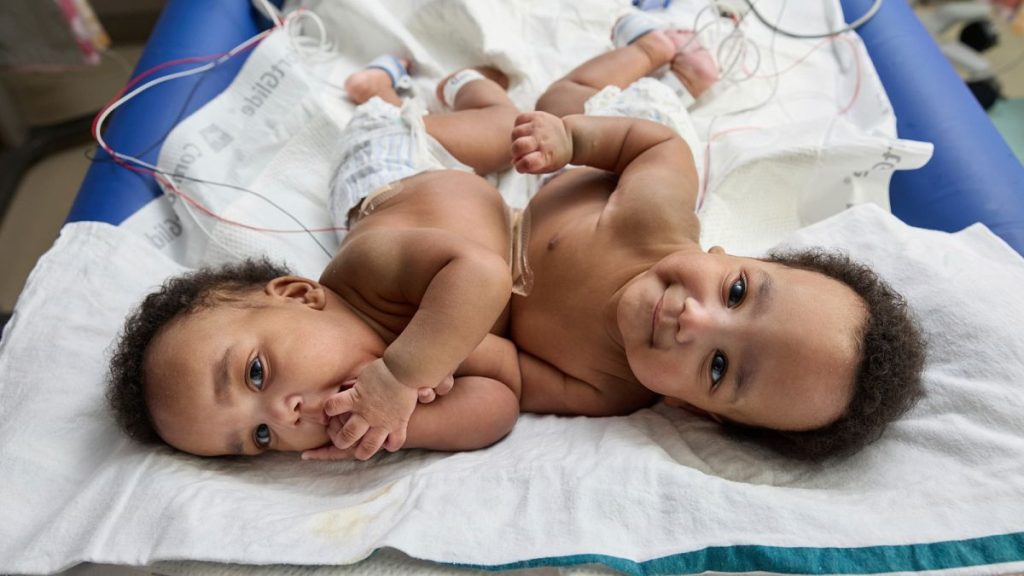 This photo provided by the Children’s Hospital of Philadelphia shows conjoined twins, Amari and Javar Ruffin, at the Children’s Hospital of Philadelphia, March 20, 2024.