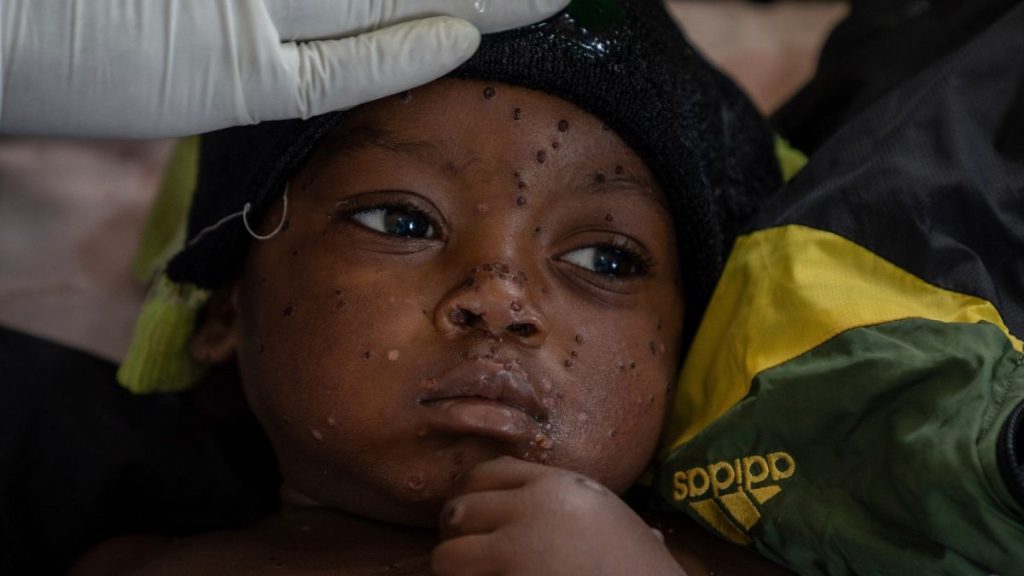 A two year old who has mpox lies in a hospital, in Kamituga, South Kivu province.