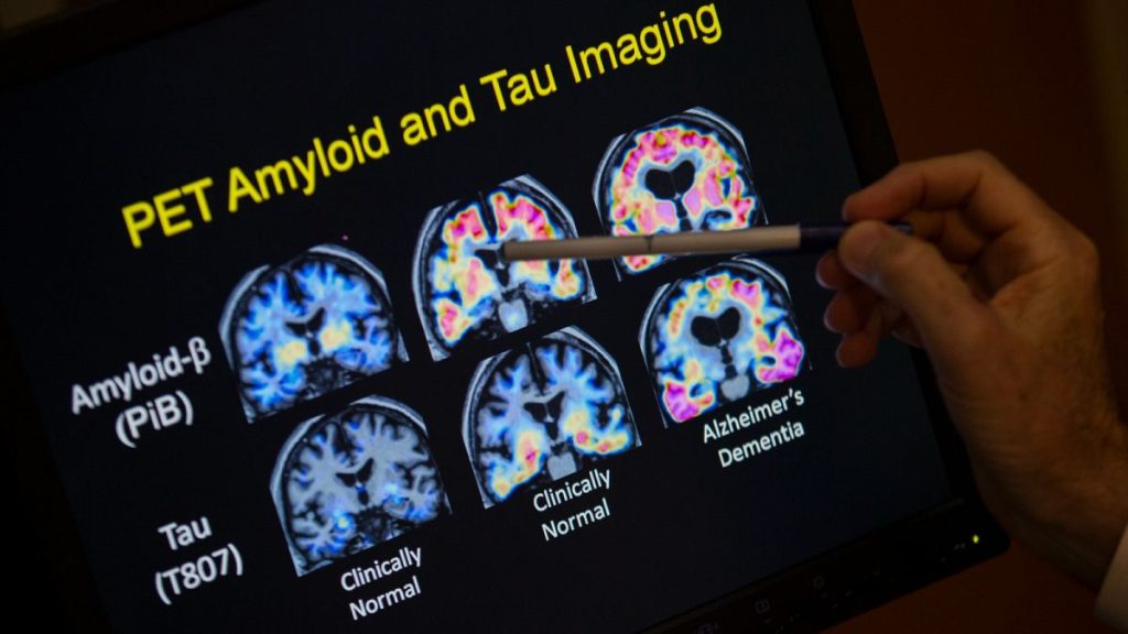 A professor points to PET scan results that are part of a study on Alzheimer